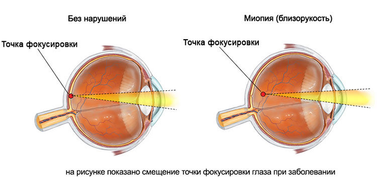 Миопия глаза лечение Miopiya