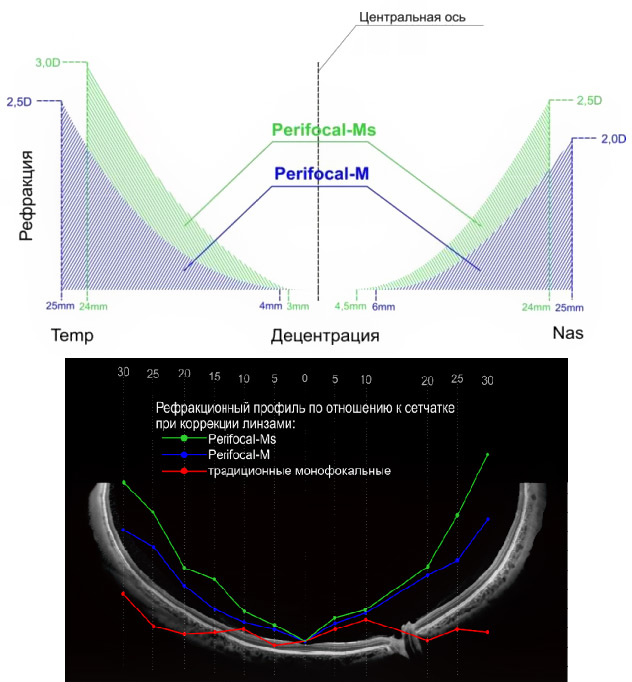 Perifocal-Ms – диапазон центральной рефракции